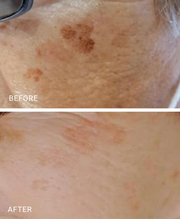 face treatment