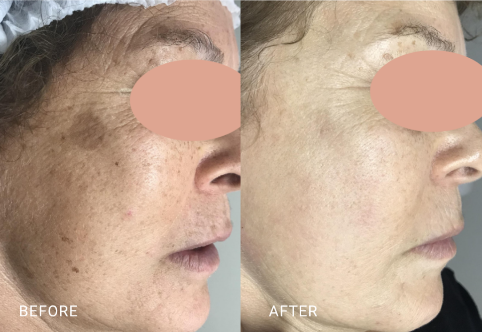 face treatment