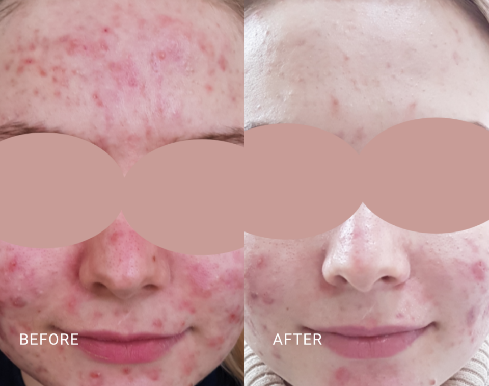 face treatment