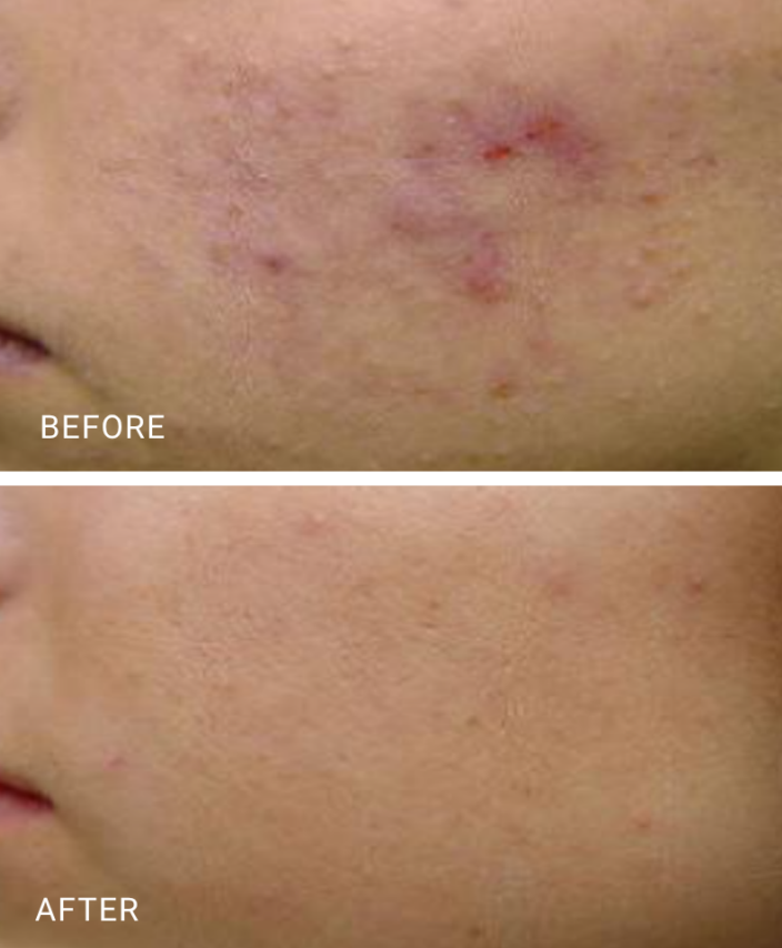 face treatment