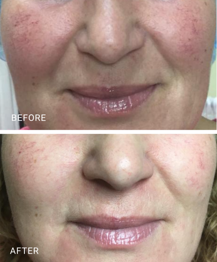 face treatment