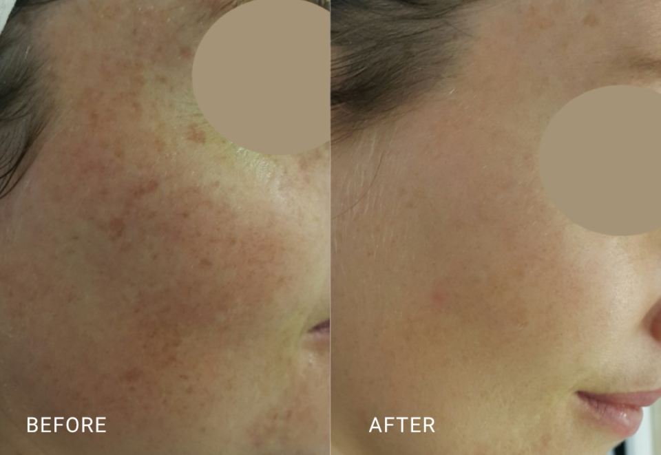 face treatment