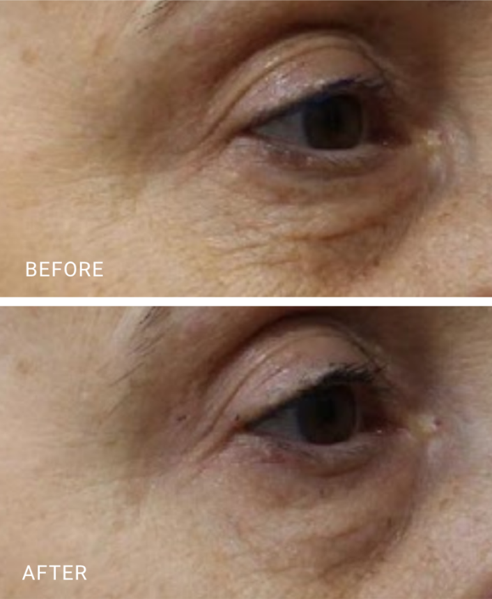 face treatment