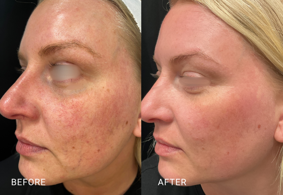 face treatment