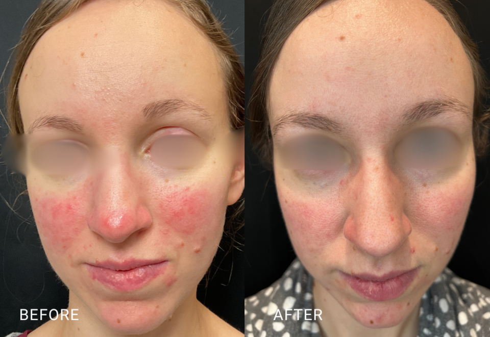 face treatment