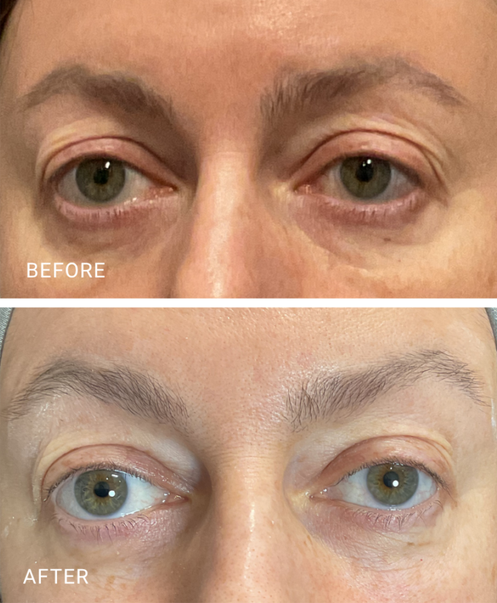 face treatment