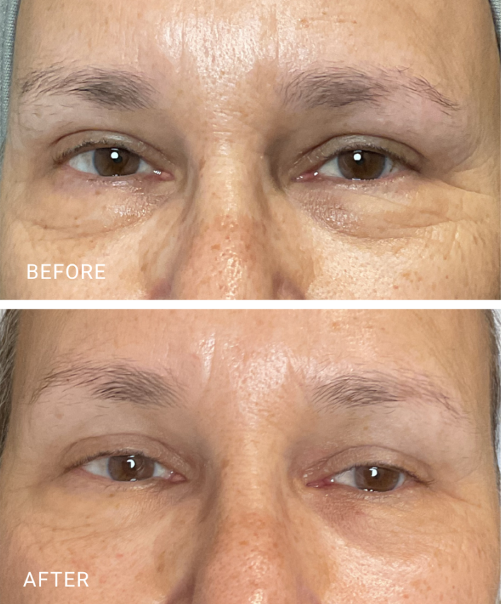 face treatment