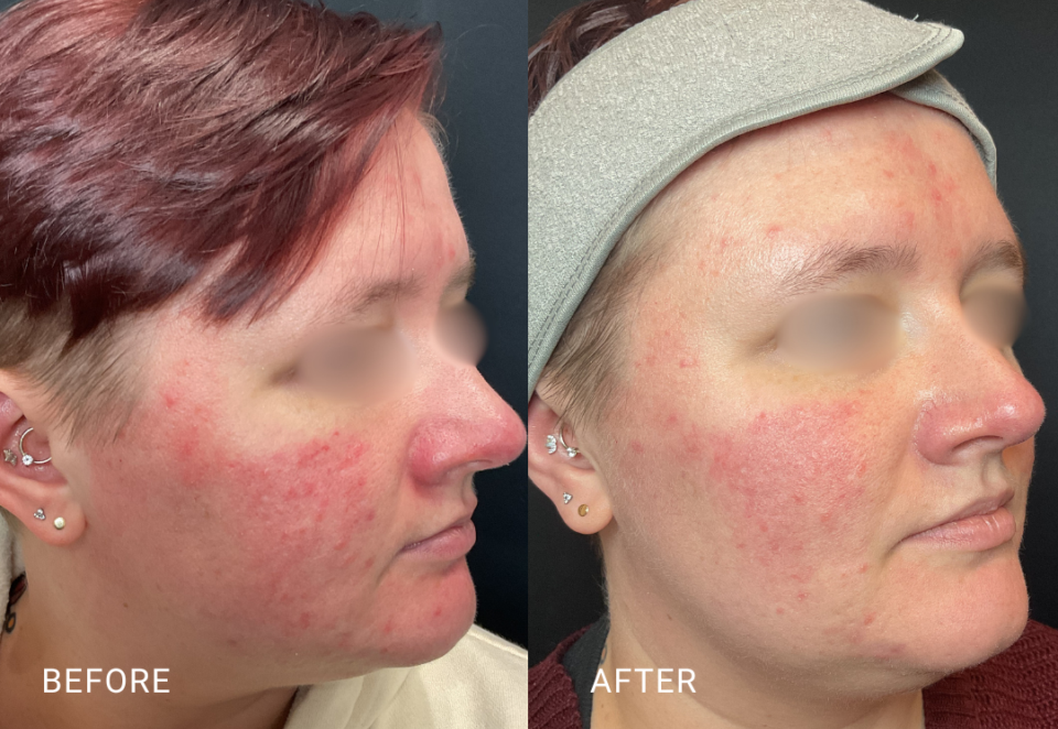 face treatment