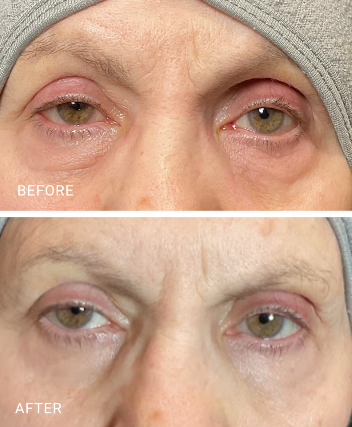 face treatment