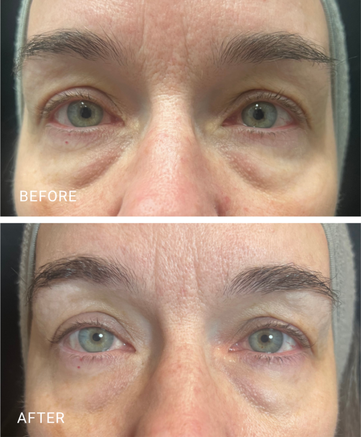 face treatment