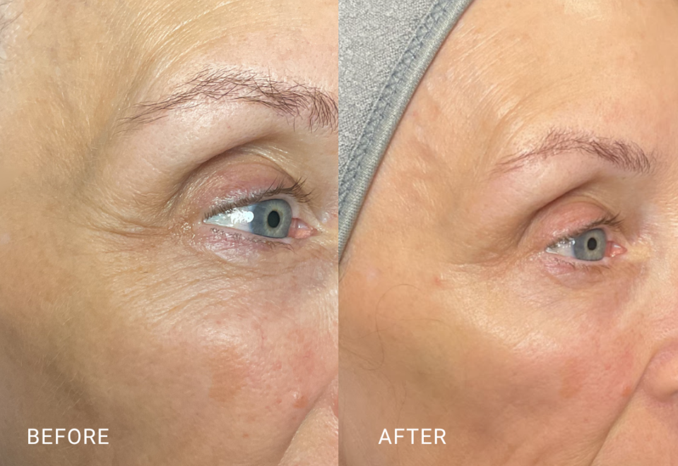 face treatment