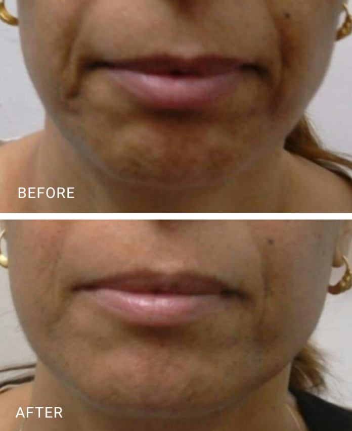 face treatment