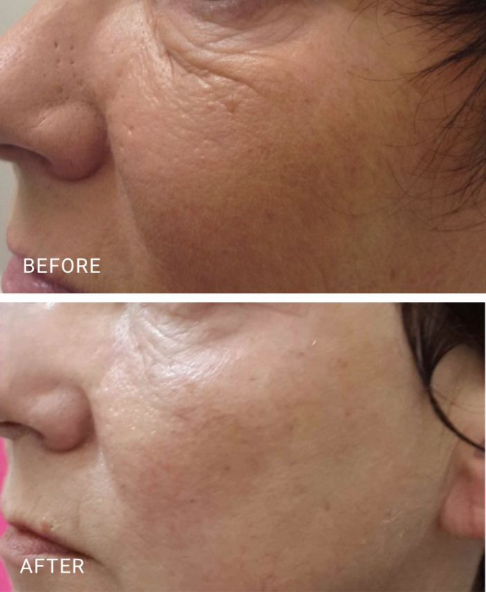face treatment
