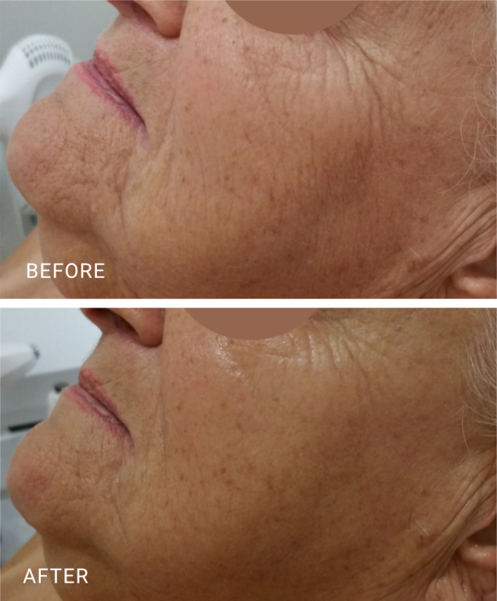 face treatment