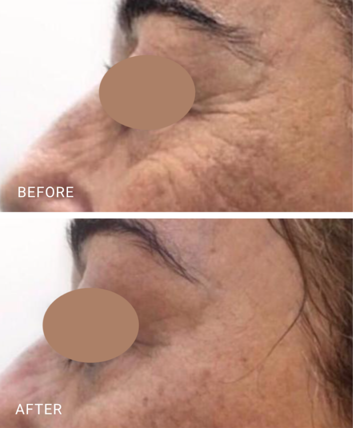 face treatment